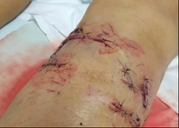 PITBULL AVANÇA EM CRIANÇA DE 1 ANO E AVÓ É MORDIDA AO DEFENDER O NETO